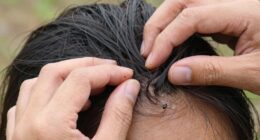 check for tick bites