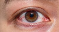 persistent eye redness warning